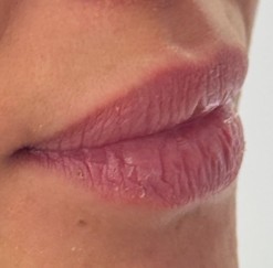 Resultado de armonización de labios, antes del procedimiento