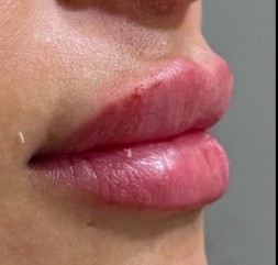 Resultado de armonización de labios, después del procedimiento