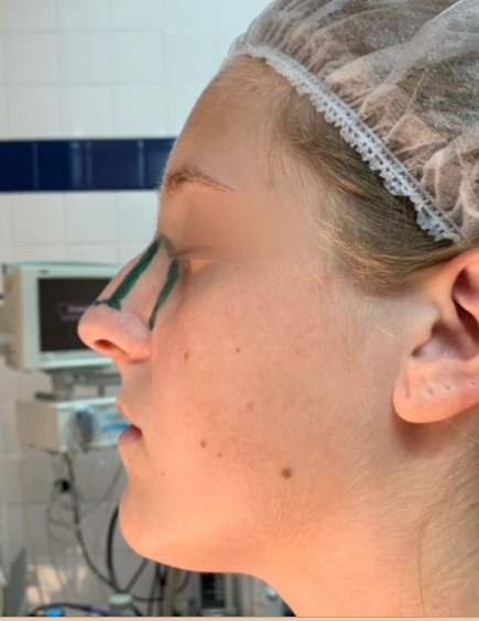 Resultado de rinoplastia, antes de la cirugía, vista de perfil