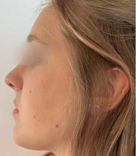 Resultado de rinoplastia, después de la cirugía, vista de perfil