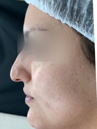 Resultado de rinoplastia, antes de la cirugía, segundo caso