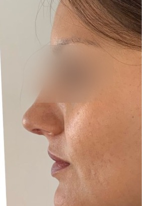 Resultado de rinoplastia, después de la cirugía, segundo caso